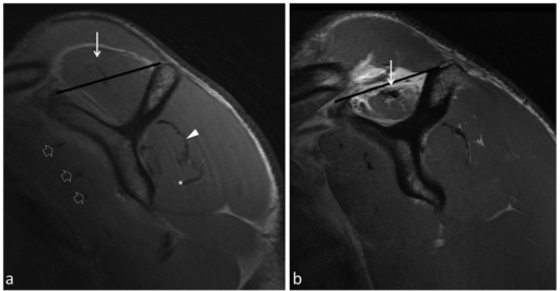 (a) Oblique sagittal PDw FSE image shows normal anatomy | Open-i