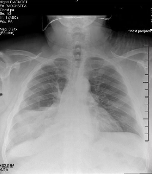 Chest X-ray PA/LT showing haziness of the right lower l | Open-i