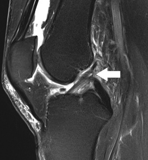 Sagittal fat-saturated T2-weighted image shows abnormal | Open-i