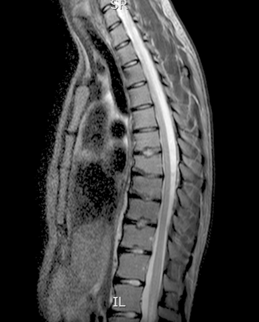 Thoracic magnetic resonance imaging revealing multiple | Open-i