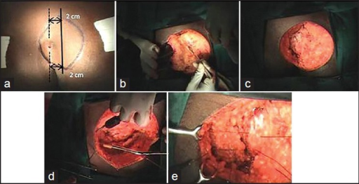 a, b, c. A. Marking of the incision containing the pilonidal cyst and 2