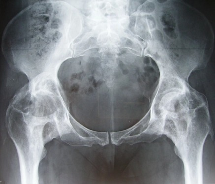 Radiographie standard du bassin de face montrant des os | Open-i