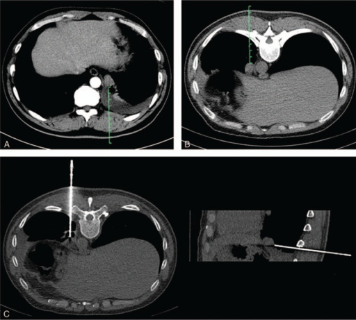 A CT-guided PTNB for a lesion in the posterior region ( | Open-i