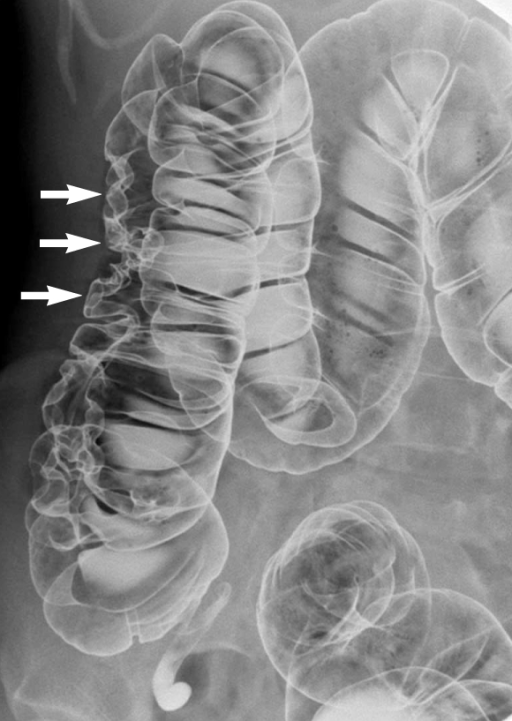 Air Contrast Barium Enema Showed Multiple Thumbprint li Open i