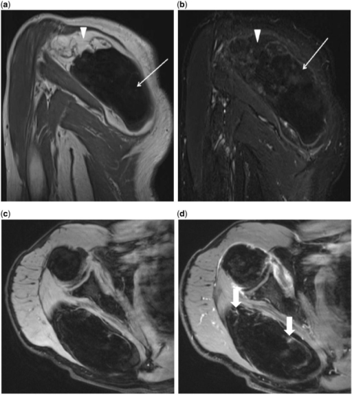 A Oblique Coronal T1 Weighted Mri Of The Right Should Open I