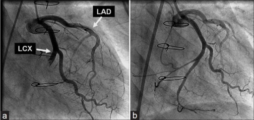 (a) Invasive Coronary Angiography That Demonstrated Tot | Open-i