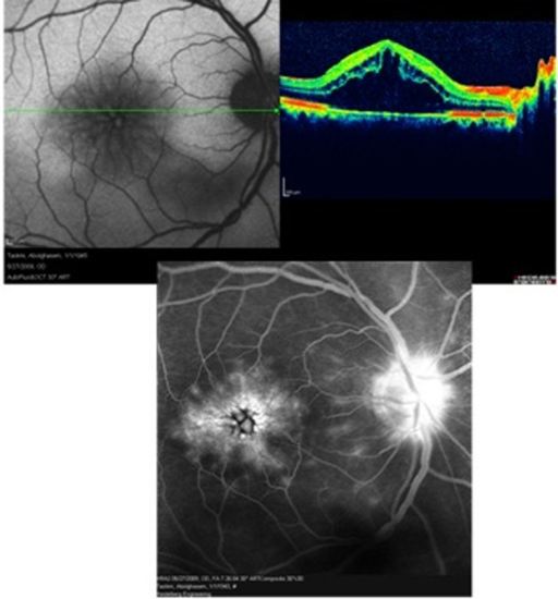  Irvine Gass Syndrome post Cataract Surgery Cystoid Mac Open i