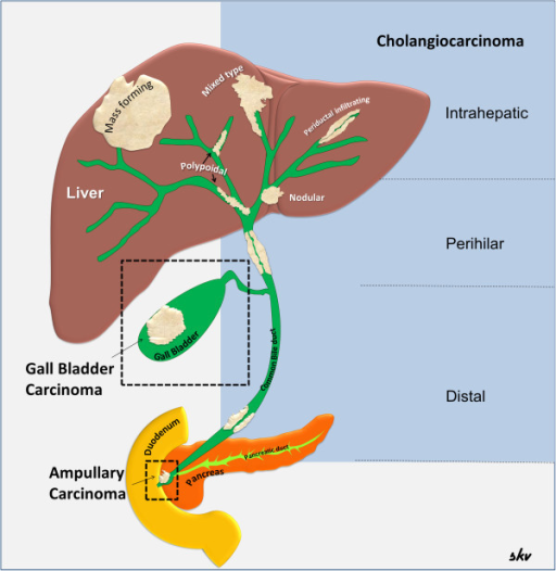 Malignancies of the biliary tract. Diagram showing the | Open-i