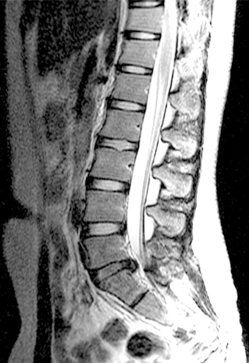 Mri Scan Sagittal View Lumbosacral Spine Has Straight - vrogue.co