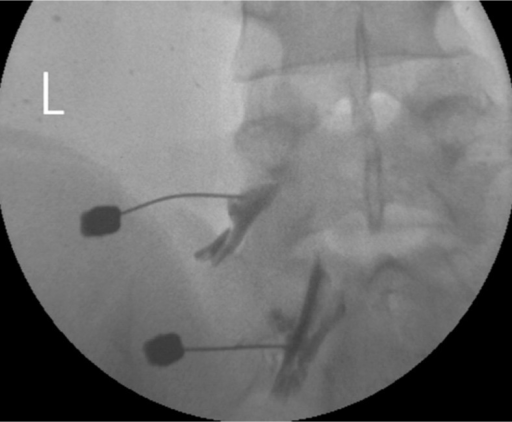 Epidural Steroid Injection Via The Transforaminal Appro Open I