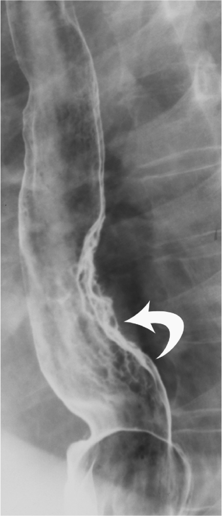 What Is A Double Contrast Esophagram