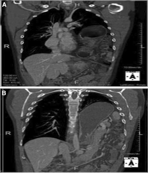 A B Computed tomography scan of the chest. Coronal re Open i