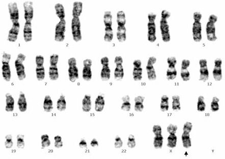 Chromosome analysis by G-banding technique revealed 47, | Open-i