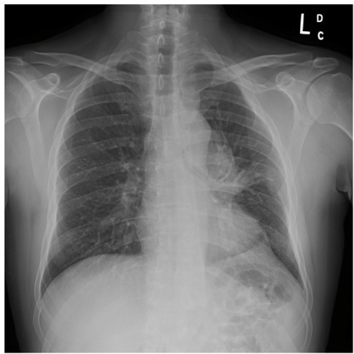 Posterior Anterior Chest X Ray Demonstrates Satisfactor Open I