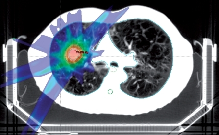 SBRT for a limited stage non-small cell lung cancer. Co | Open-i