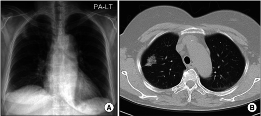 Chest Radiograph Ground Glass