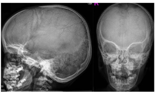 Skull radiographs show brachycephalic skull with increa | Open-i