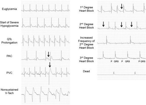 Ecg Changes In Response To Severe Hypoglycemia Study 3 Open I