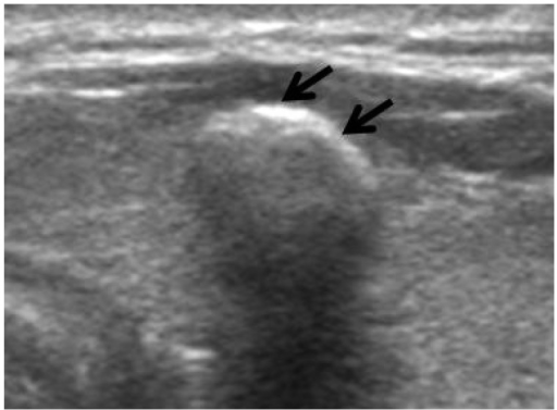 benign thyroid nodules