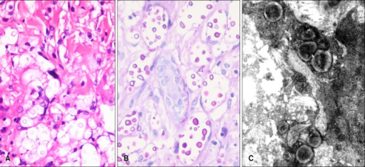 mortality rate of cryptococcus neoformans 2006-3-8 clinical characteristics and predictors of mortality for cryptococcus gattii infection in dogs and cats of southwestern british columbia. mortality rate of cryptococcus neoformans 2006-3-8 clinical characteristics and predictors of mortality for cryptococcus gattii infection in dogs and cats of southwestern british columbia.