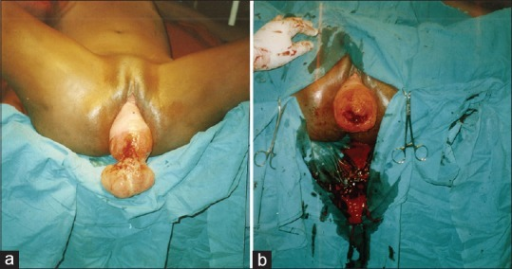 Cervical cancer in association with irreducible uterine prolapse.