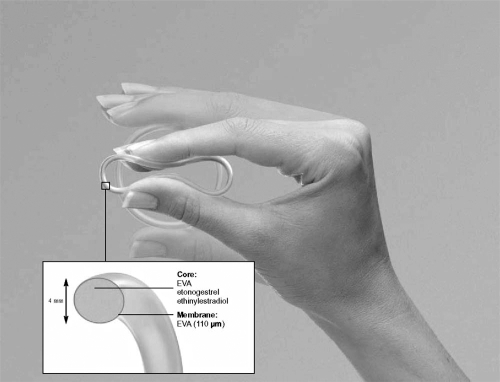 The Combined Contraceptive Vaginal Ring NuvaRing Open I