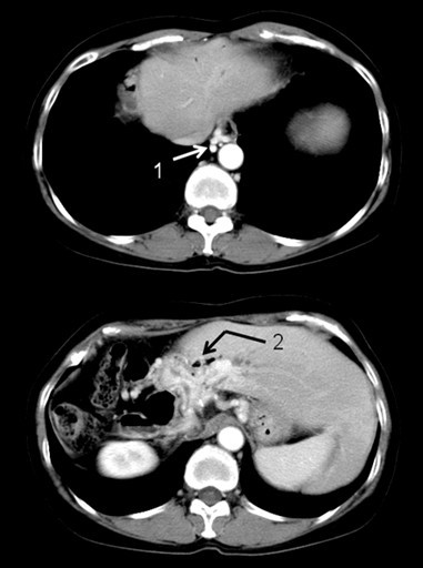 Gastric Varices Ct