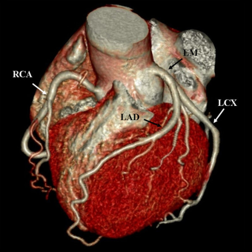 volume-rendering-image-shows-the-branches-of-coronary-a-open-i