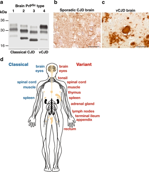 Variant Creutzfeldt-Jakob Disease (vCJD) Is A Distinct | Open-i