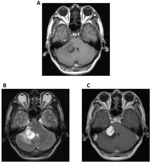 MRI showed a solid cystic lesion in the right CPA that | Open-i