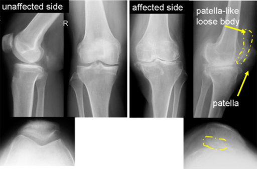 Patellofemoral Syndrome X Ray