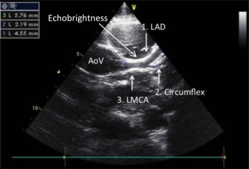 coronary-artery-disease-progression-captions-blog