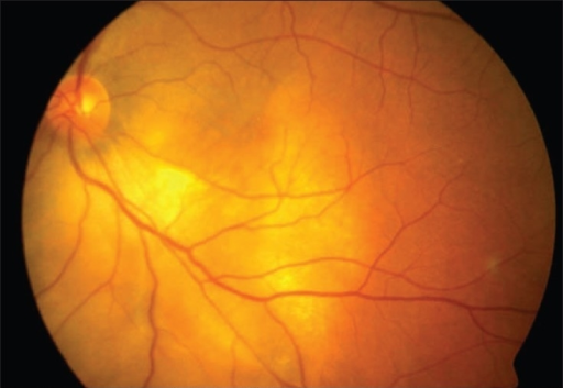 a: Color fundus photograph of the left eye showing the | Open-i