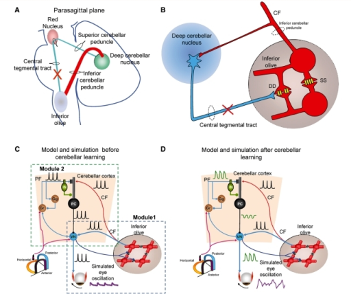 Schematic representation of the Guillain–Mollaret tri | Open-i