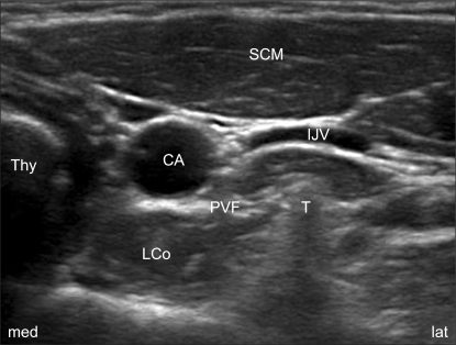 Sonoanatomy for an ultrasound-guided SGB: the transvers | Open-i