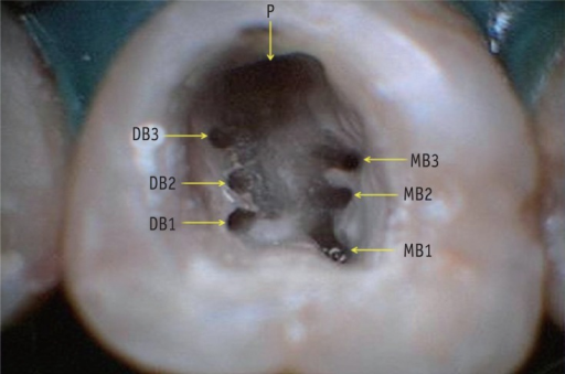 Access chamber showing seven root canal orifices of too | Open-i