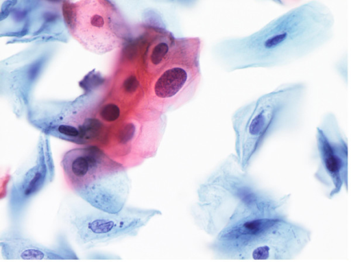 Low Grade Squamous Intraepithelial Lesion With Mildly D Open I 