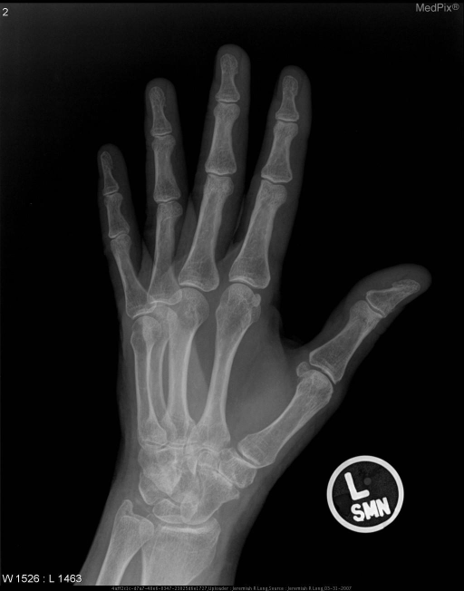 frontal-lateral-and-oblique-radiographs-of-the-left-ha-open-i