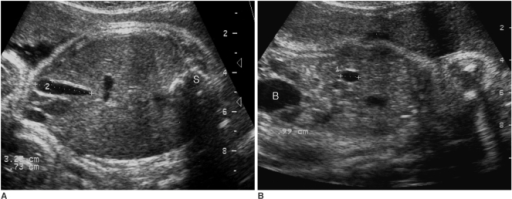 Sonogram demonstrating fetal gall bladder length and wi | Open-i