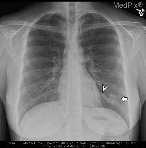 AP view of the chest demonstrates a solitary pulmonary nodule (arrow ...