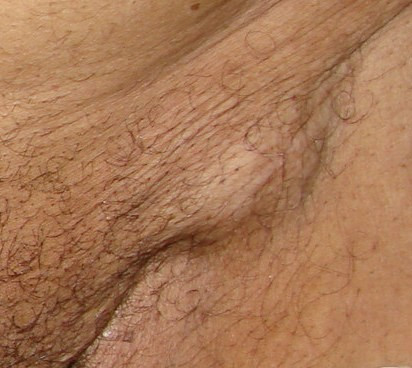 swollen lymph nodes in groin female pictures