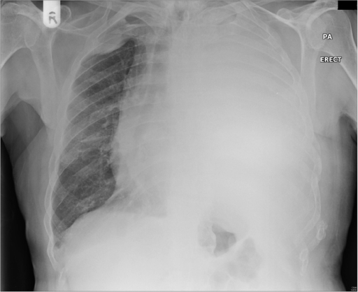 Chest Radiograph Showing Left Apical Pleural Cap Arrow Reconstructed Images