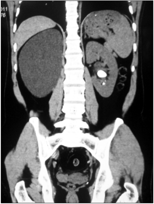 Pre Operative Coronal Ct View Of Patient With Left Rena Open I