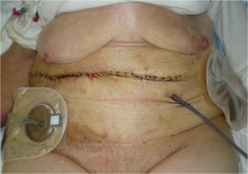 Skin defect closure with reverse abdominoplasty flap.