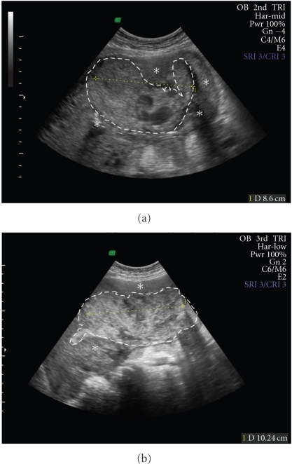 postpartum retained placental fragments pathophysiology