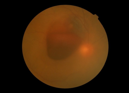 Color Fundus Photograph Of The Right Eye 1 Media Haziness Due To Vitreous Hemorrhage Color Fundus Photograph Of The Right Eye 1 Media Haziness Due To Vitreous Hemorrhage