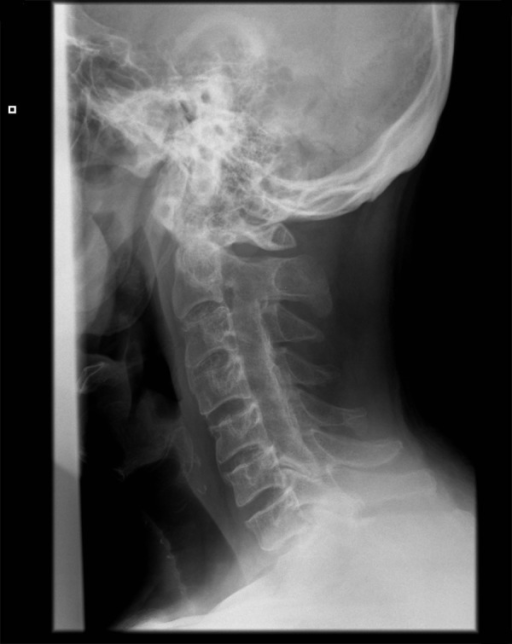 Lateral x-ray of cervical spine: anterior dislocation, | Open-i