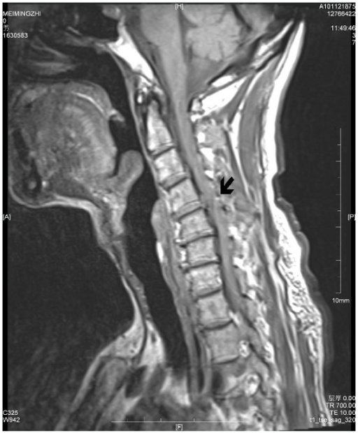 T2-weighted MRI demonstrates disc protrusion at C3-C4, | Open-i