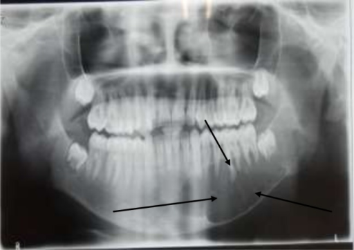 Opg Showing Multilocular Radiolucency In The Left Mandi Open I