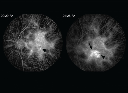 Fluorescein Angiogram FA Transiting The Left Eye Reveals Diffuse Atrophy Of Choriocapillaris Sparing Fluorescein Angiogram FA Transiting The Left Eye Reveals Diffuse Atrophy Of Choriocapillaris Sparing